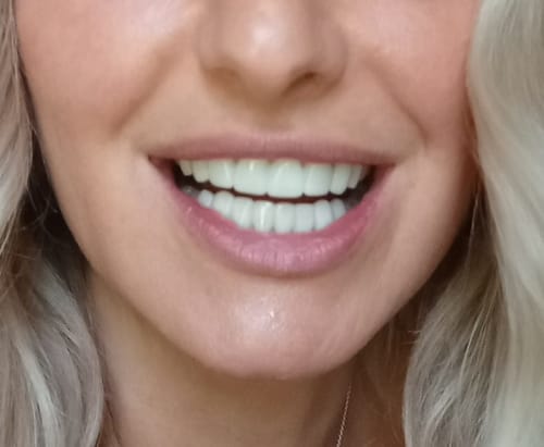 Customer photo review of Teeth-Veneer 2.0