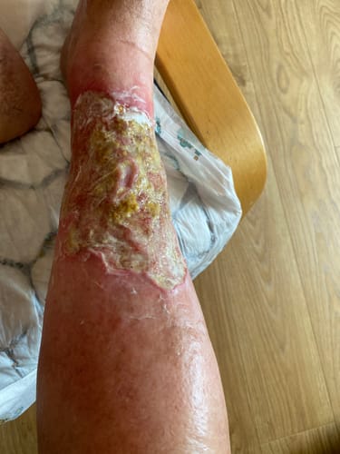 Customer photo review of Tattoo Numbing Cream - 5% Lidocaine Tattoo Numbing Cream