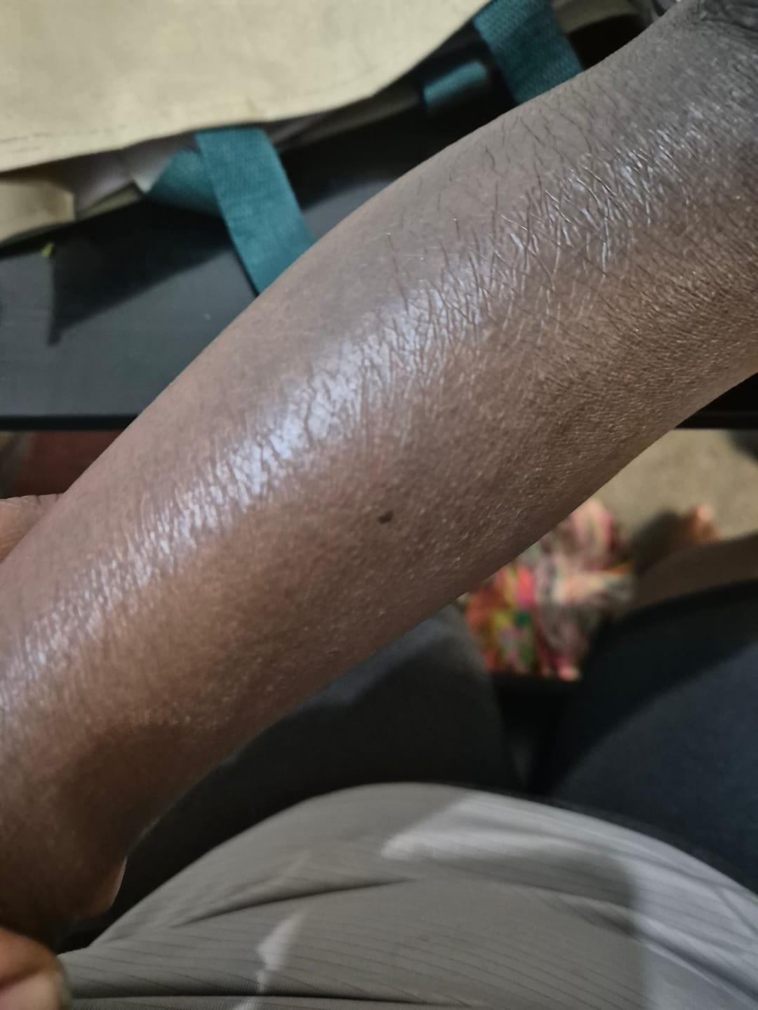 Customer photo review of Bioskin Zeoderm Skin Repair Moisturiser