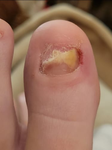 Customer photo review of Onychom - Antifungal Laser Device