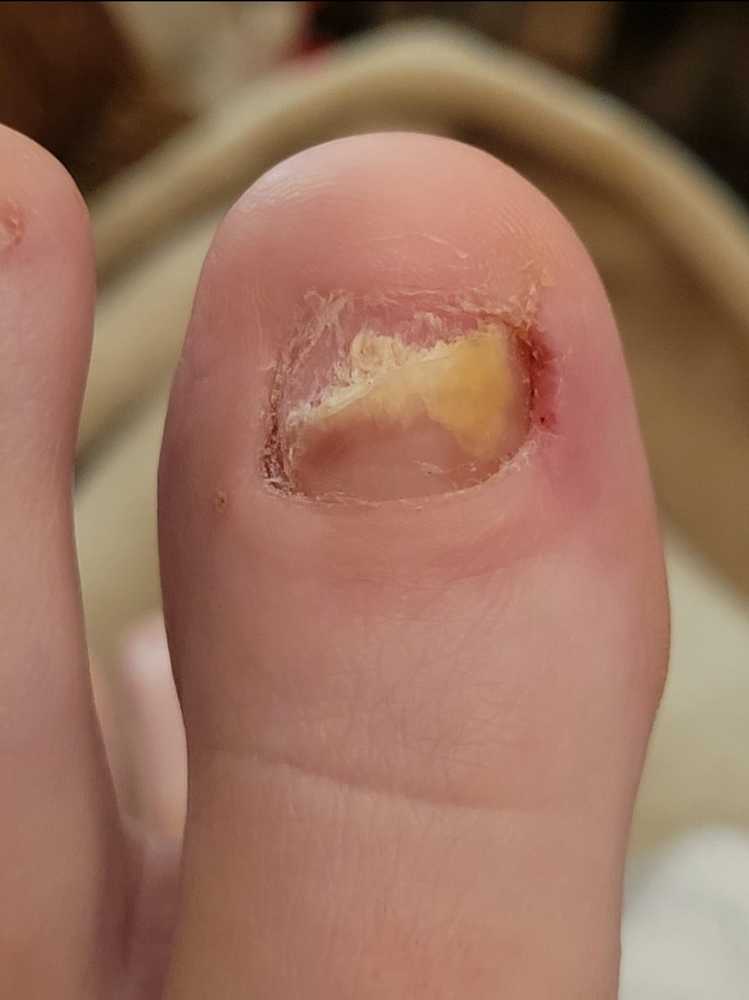 Customer photo review of Onychom Pro Antifungal LED Device
