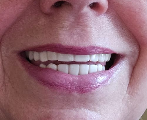 Customer photo review of Teeth-Veneer 2.0