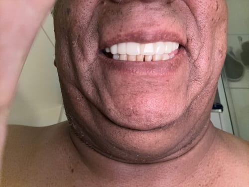 Customer photo review of Teeth-Veneer 2.0