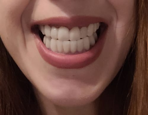 Customer photo review of Teeth-Veneer 2.0