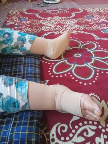 Customer photo review of Medical Compression - Class 2 Thigh Length|Mild Support | Improves Blood Circulation | Swollen | Tired | Aching Legs  (Beige)