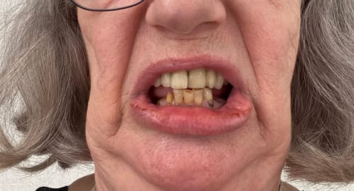 Customer photo review of Teeth-Veneer 2.0