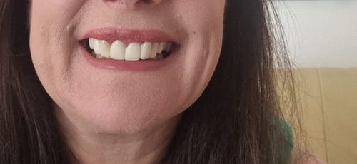 Customer photo review of Teeth-Veneer 2.0