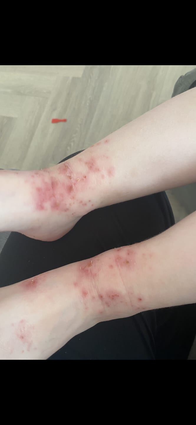 Customer photo review of Bioskin Junior Duo Pack (Free Outbreak Rescue Cream)