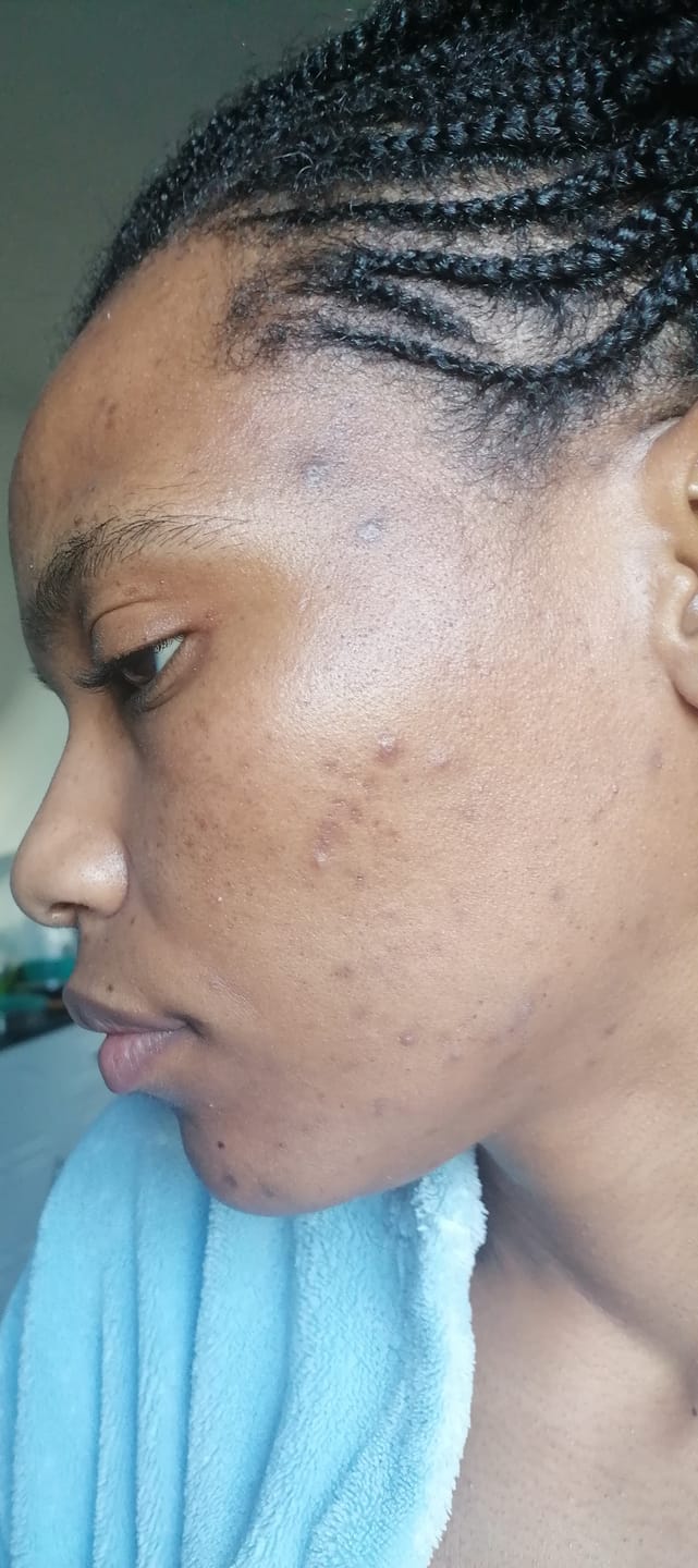 Customer photo review of Gmaeum Clear Complexion Set