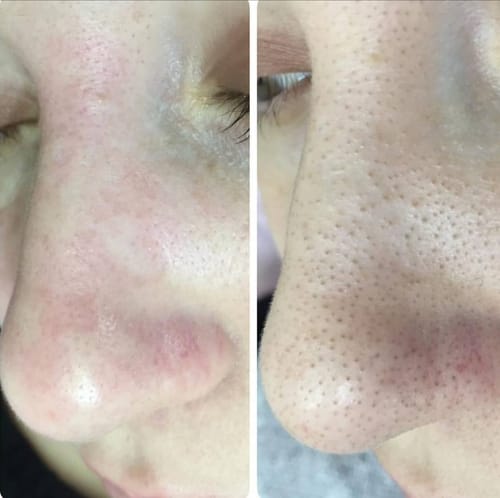 Customer photo review of Diystar™ Deep Cleanse & Bacteria-Fighting Green Tea Mask