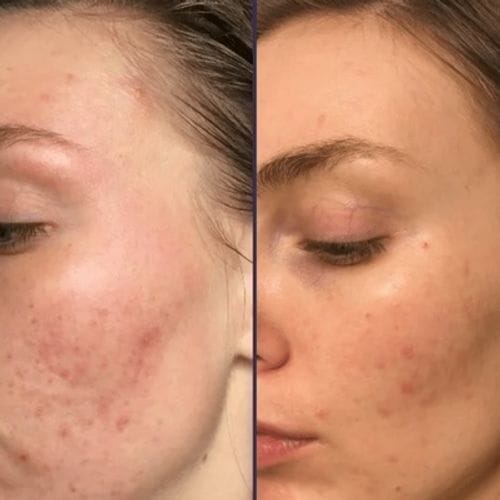 Customer photo review of Diystar™ Deep Cleanse & Bacteria-Fighting Green Tea Mask