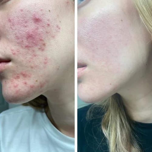 Customer photo review of Diystar™ Deep Cleanse & Bacteria-Fighting Green Tea Mask