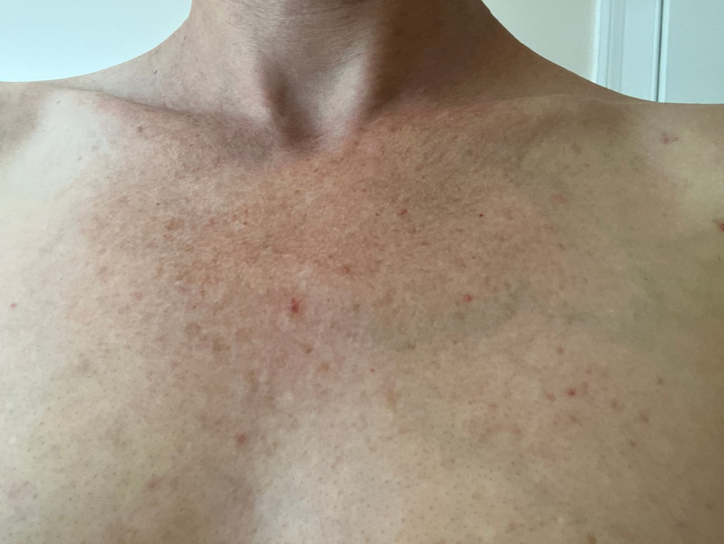 Customer photo review of The Complete Acne System for Women