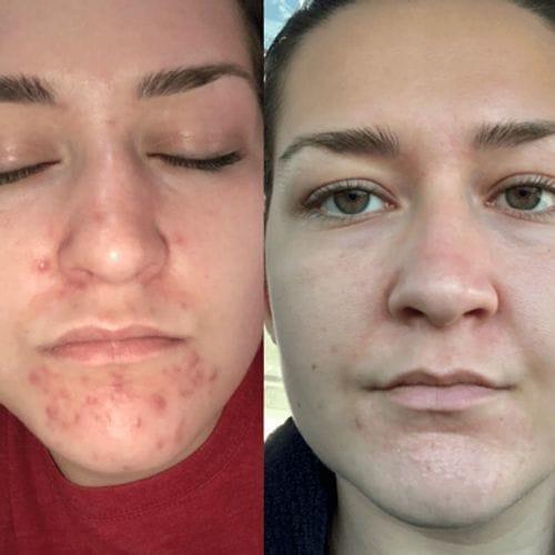 Customer photo review of Diystar™ Deep Cleanse & Bacteria-Fighting Green Tea Mask