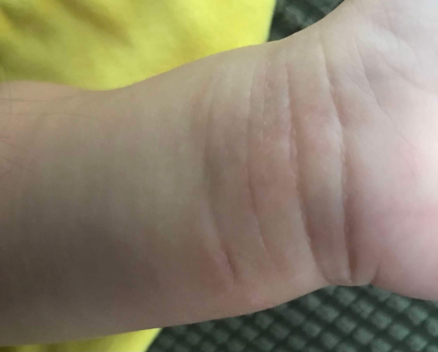 Customer photo review of Bioskin Junior Duo Pack (Free Outbreak Rescue Cream)
