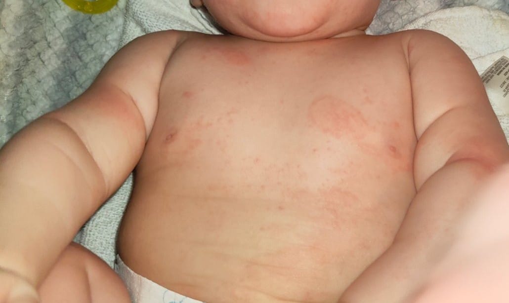 Customer photo review of Eczema Saviour