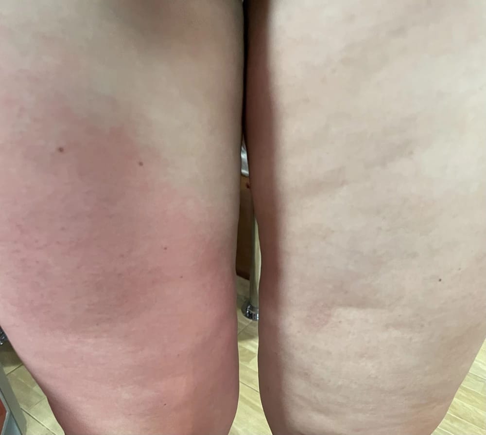 Customer photo review of Revimus Anti-Cellulite Massager