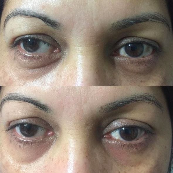 Customer photo review of Eye Roller | Eliminates Dark Circles & Puffy Eyes