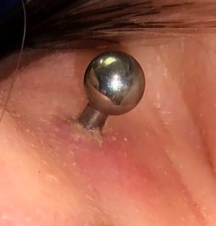 Customer photo review of Piercing Bump Treatment - Bump, Keloid & Scar Relief Oil