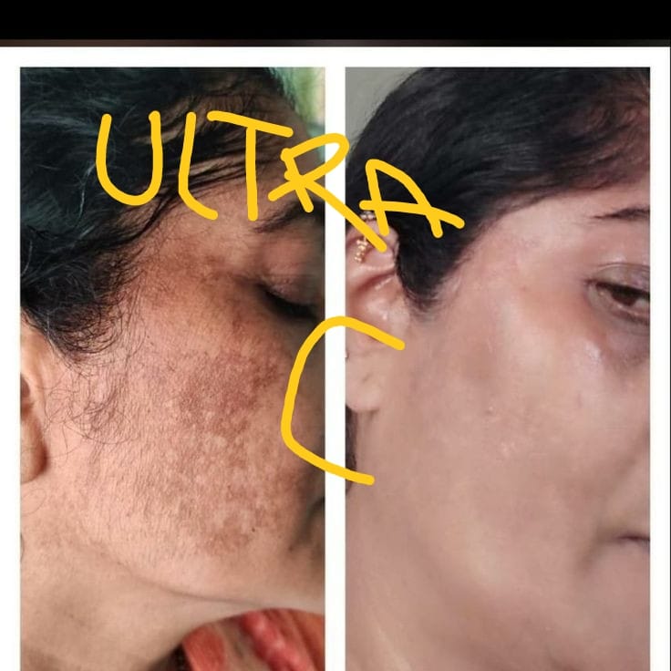 Customer photo review of Ultra C: Vitamin C Serum