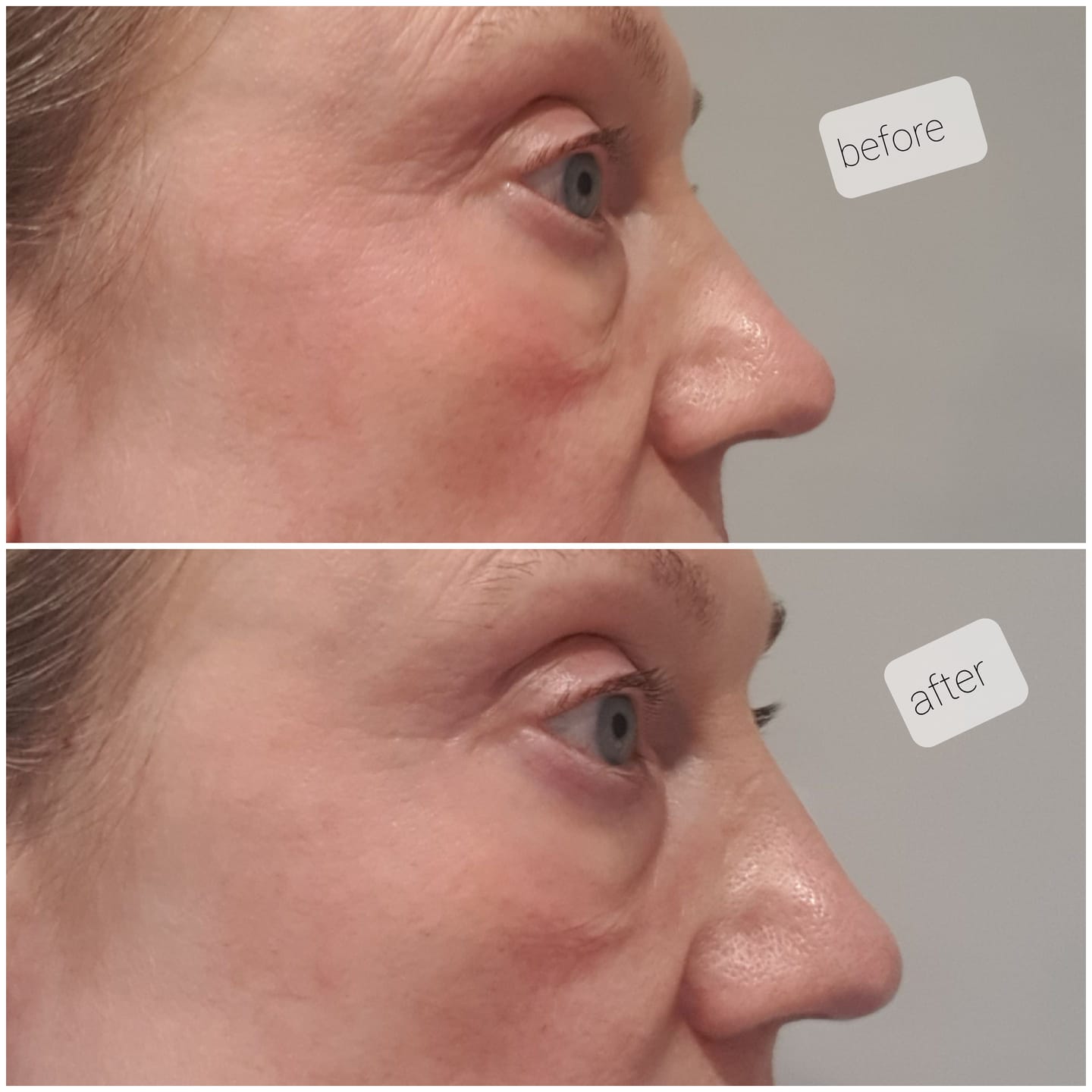Customer photo review of Anti-Fatigue Eye Mask