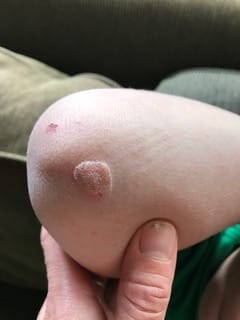 Customer photo review of The Wartabater | Electronic Wart Remover | Safe, Easy, & Effective