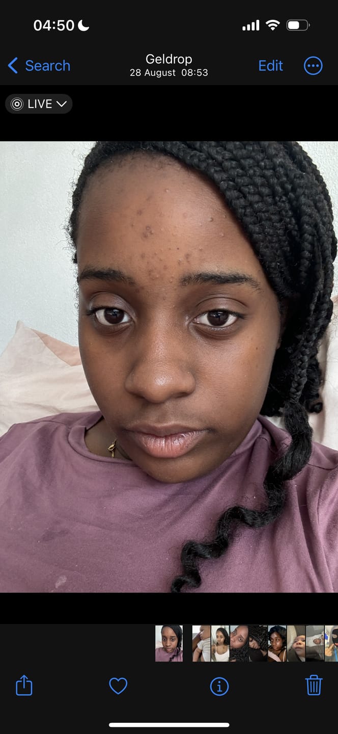 Customer photo review of Glow Wash Salicylic Acid + Sulphur  Facial Cleanser