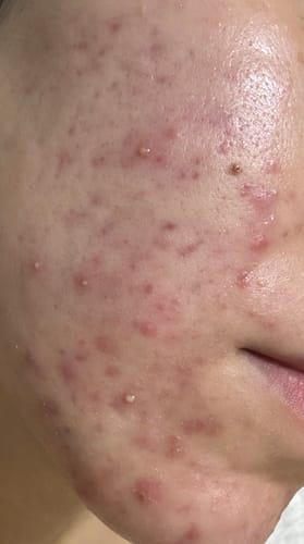 Customer photo review of Advanced Acne Program™