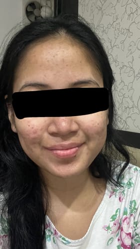 Customer photo review of Acne Repair Kit