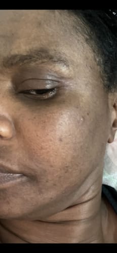Customer photo review of Anti-Acne & Dark Spots African Soap