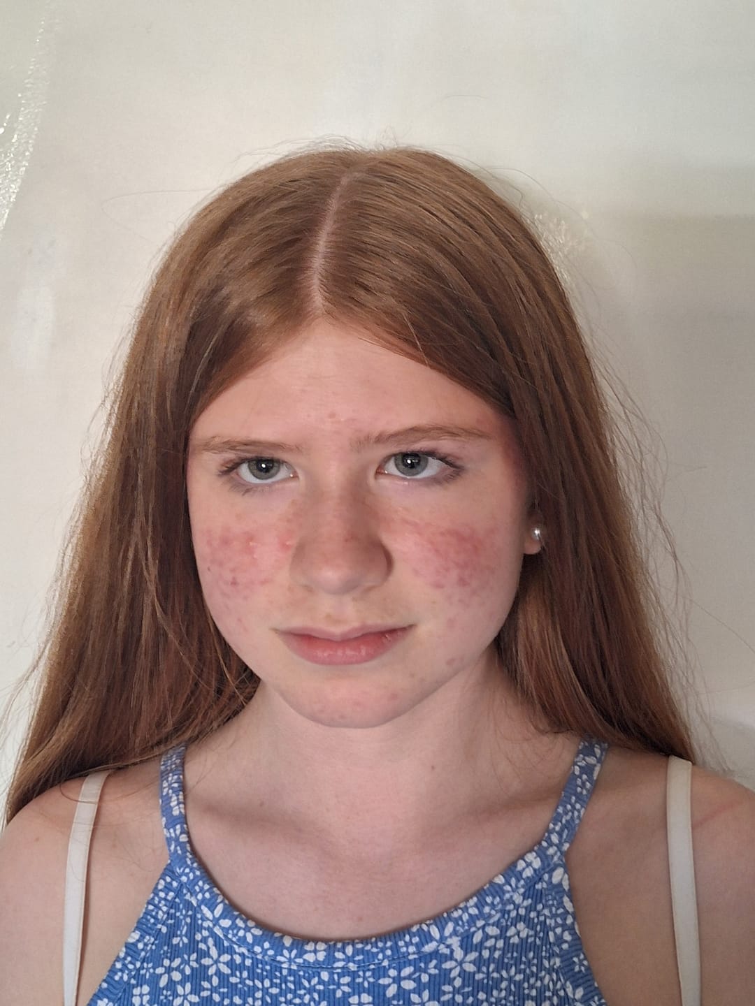 Customer photo review of Antiac Acne Rescue Pack (FREE Gel Serum)