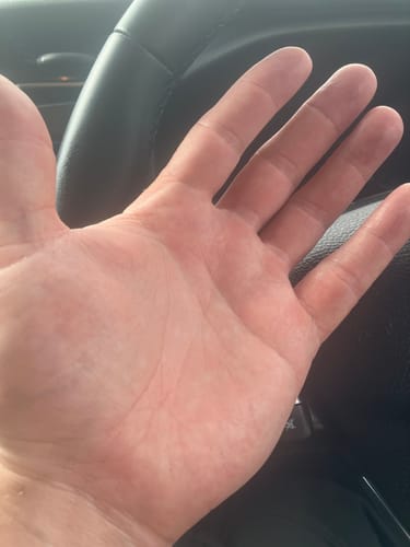 Customer photo review of Eczema Recommendations