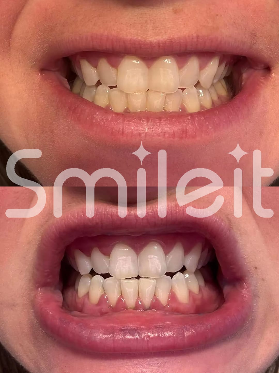Customer photo review of SmileIt V34 משחה להלבנת שיניים