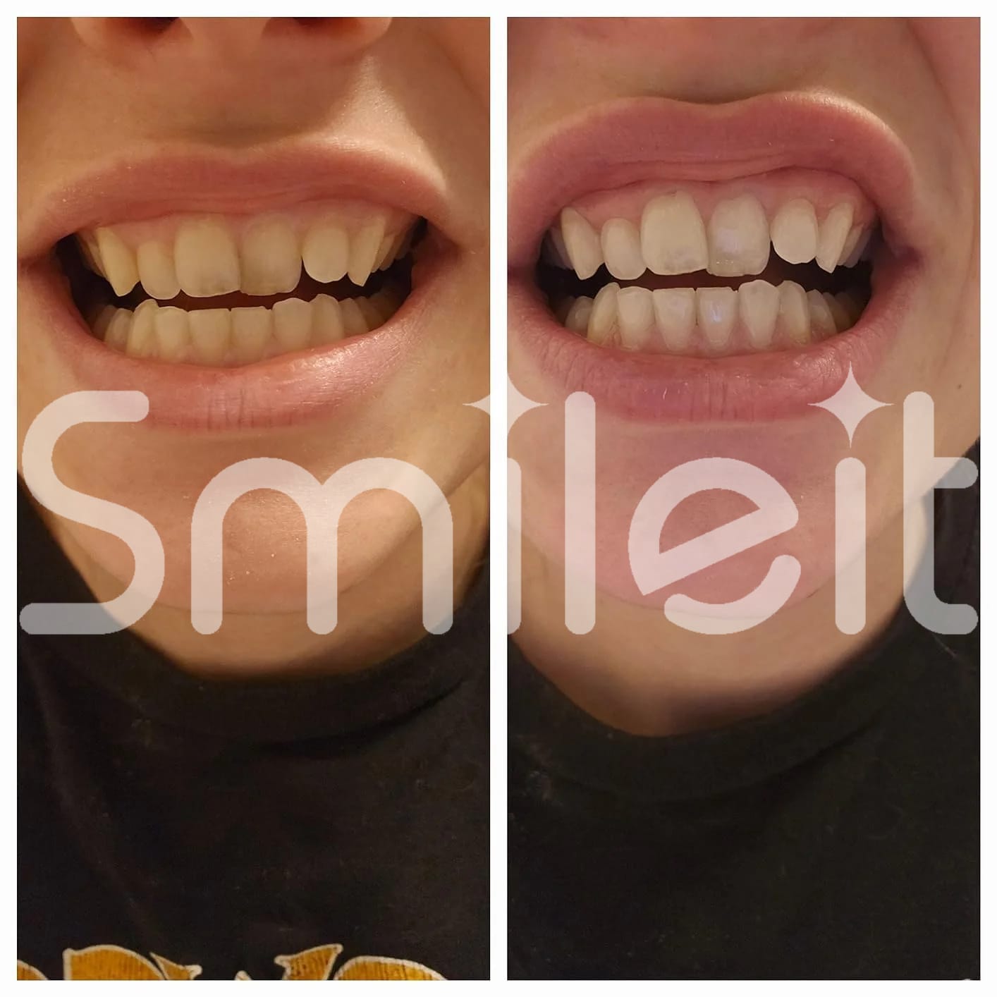Customer photo review of SmileIt V34 משחה להלבנת שיניים