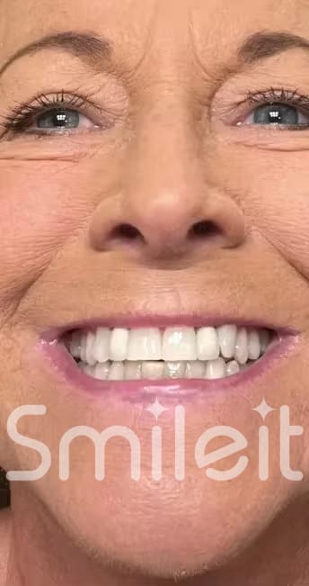 Customer photo review of SmileIt V34 משחה להלבנת שיניים