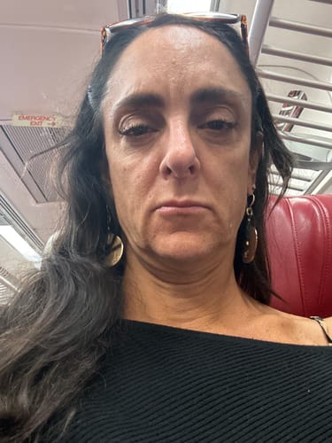 Customer photo review of WrinkleFix: Unlimited Toxins Membership Auto renew