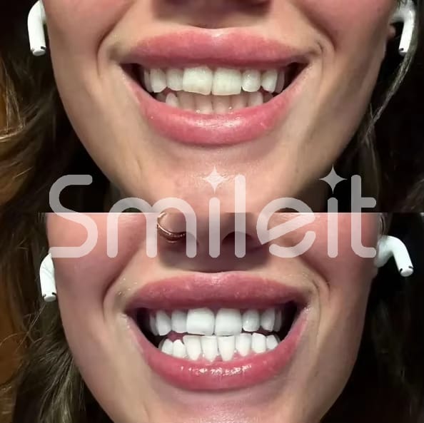 Customer photo review of SmileIt V34 משחה להלבנת שיניים
