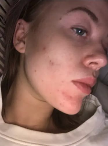 Customer photo review of Acnetane | Get rid of stubborn Acne | 60 Capsules