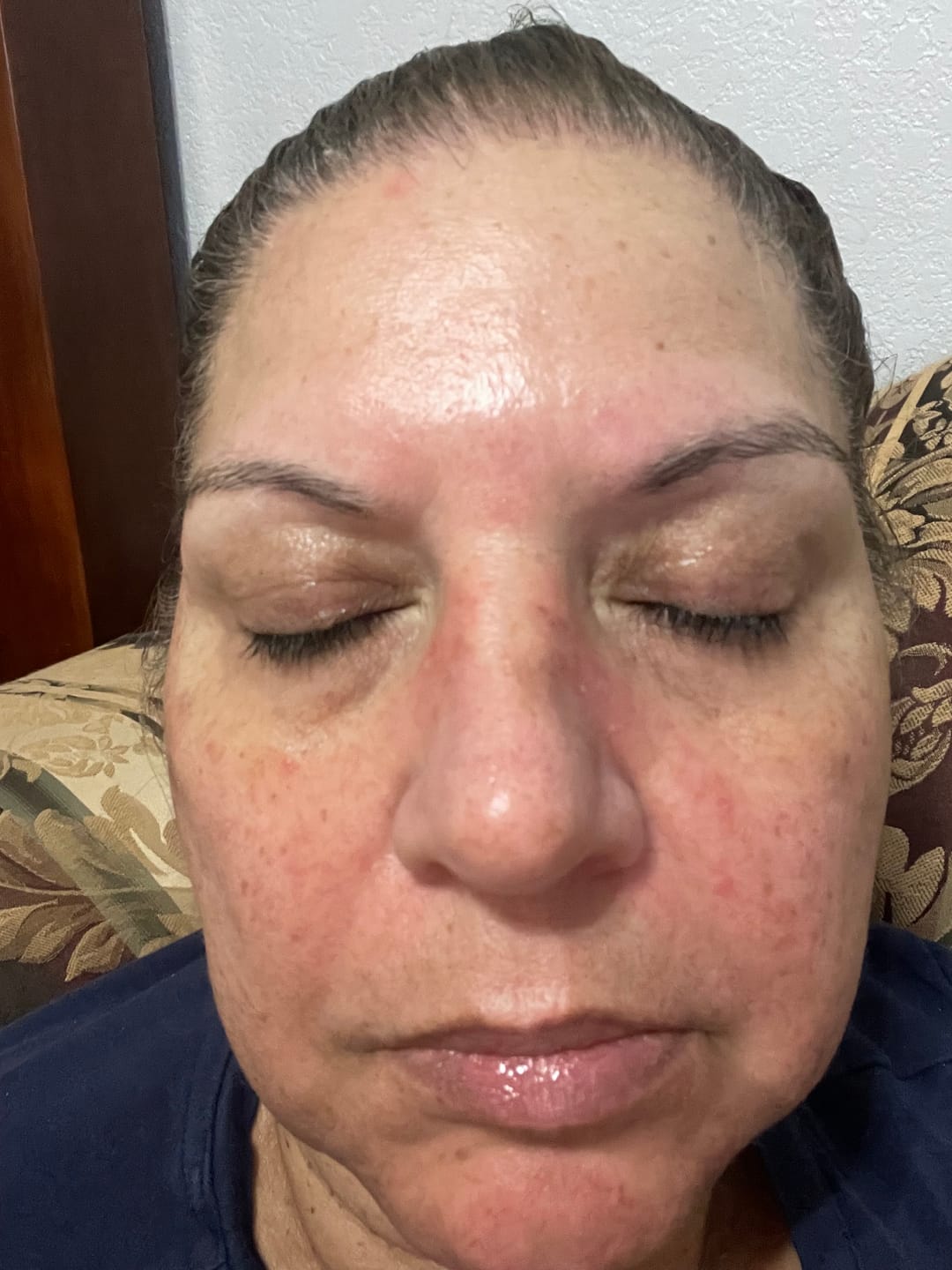 Customer photo review of Psoriasis Honey Ultimate Relief Kit