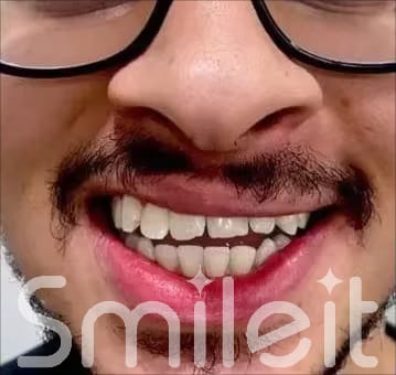 Customer photo review of SmileIt V34 משחה להלבנת שיניים