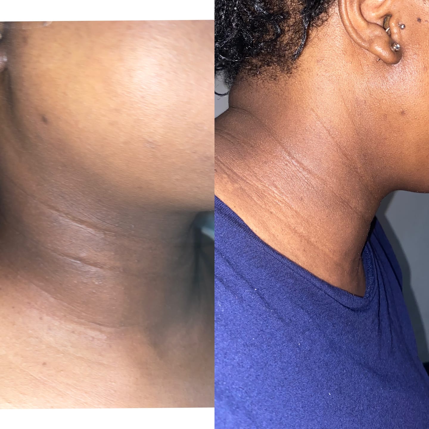 Customer photo review of Gmaeum Hyperpigmentation Capsules (3 Months Supply)