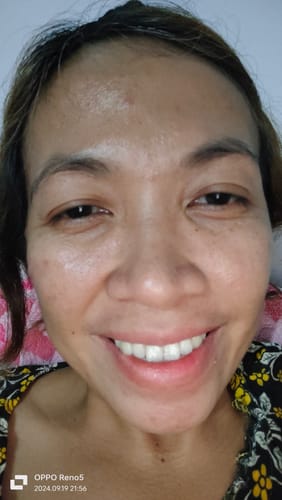 Customer photo review of Bad Skin™ Korean Collagen Bomb Hydrating Ampoule