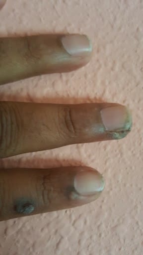 Customer photo review of The Wartabater | Electronic Wart Remover | Safe, Easy, & Effective