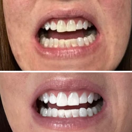 Customer photo review of Polar MD Teeth Whitening Kit