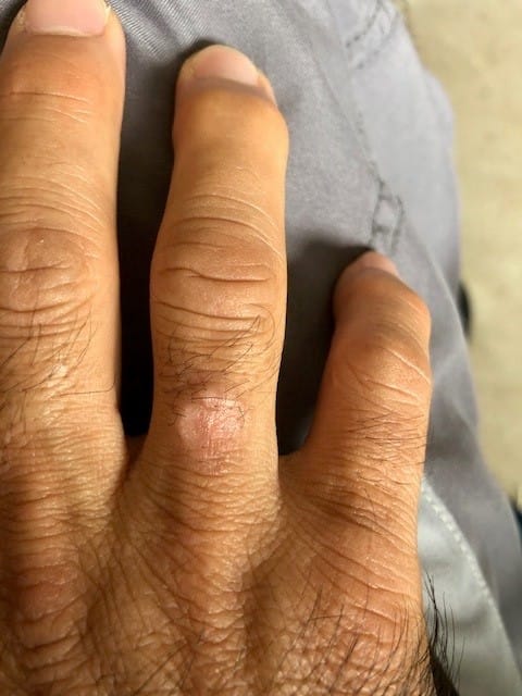 Customer photo review of The Wartabater | Electronic Wart Remover | Safe, Easy, & Effective