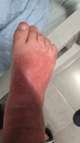 Customer photo review of קרם גוף טיפולי לעור אדמומי, מגורה ומתקלף | PSO CONTROL