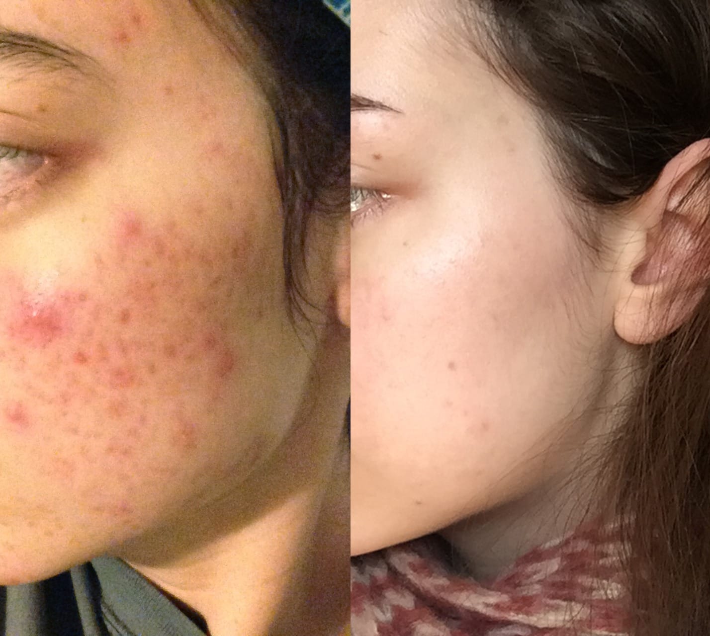 Customer photo review of Anti Acne Serum (Niacinamide & Azelaic Acid) (30ml)
