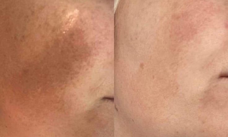Customer photo review of Ultra C: Vitamin C Serum