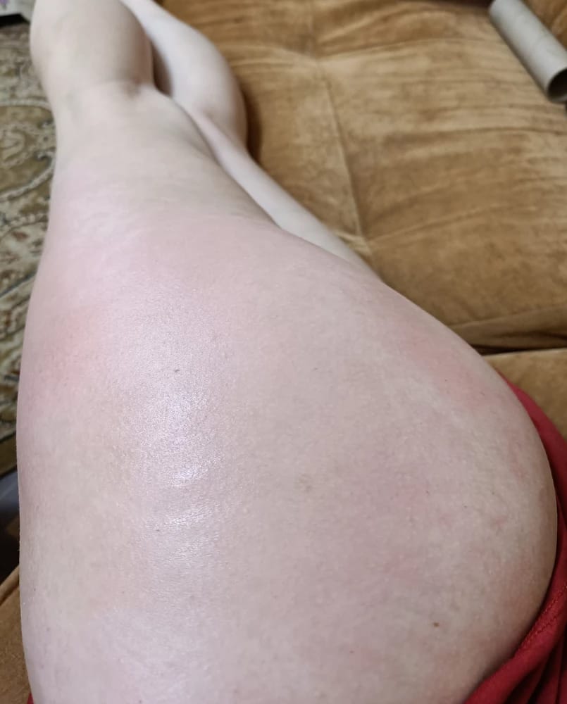 Customer photo review of Revimus Anti-Cellulite Massager