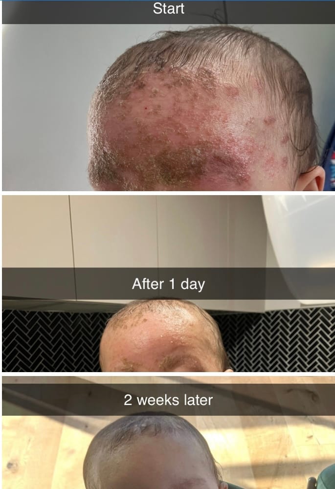 Customer photo review of Kawakawa Repair Balm - Winner, Best SOS/Healing Balm 2024